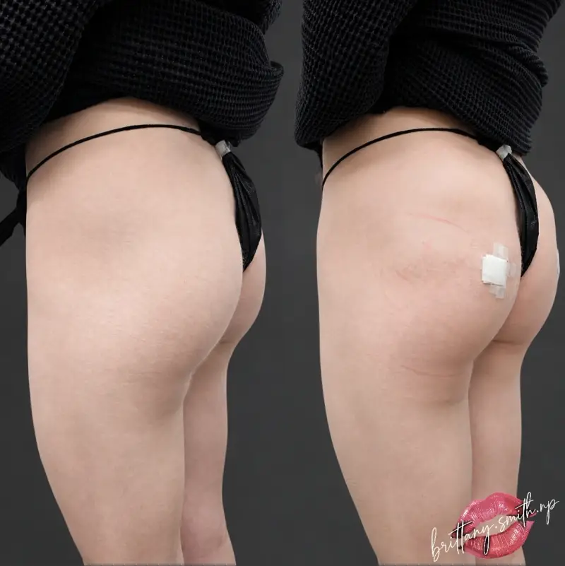 Before and after alloClae™ structural adipose filler showing added glute projection from a rear three-quarter view
