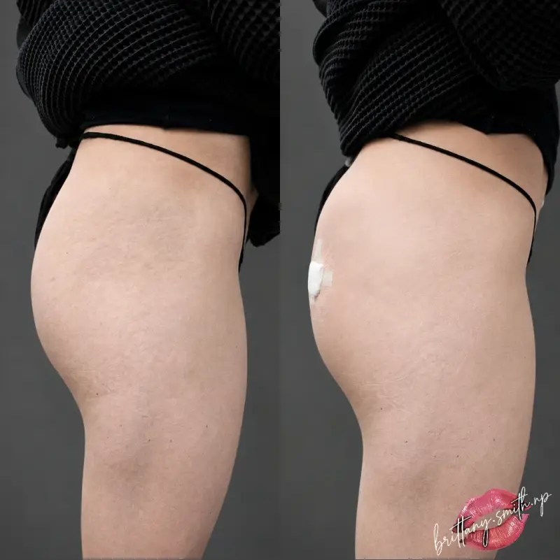 Before and after alloClae™ structural adipose filler showing a smoother hip and glute profile with softened hip dips