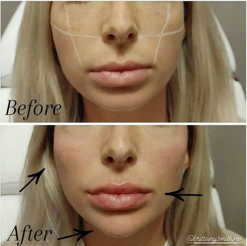 Before and after cheek filler showing restored midface volume, by Brittany Smith, FNP-C