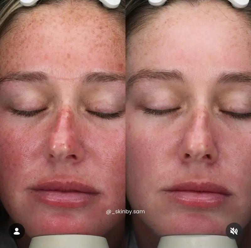 Before and after chemical peel brightening and evening the skin