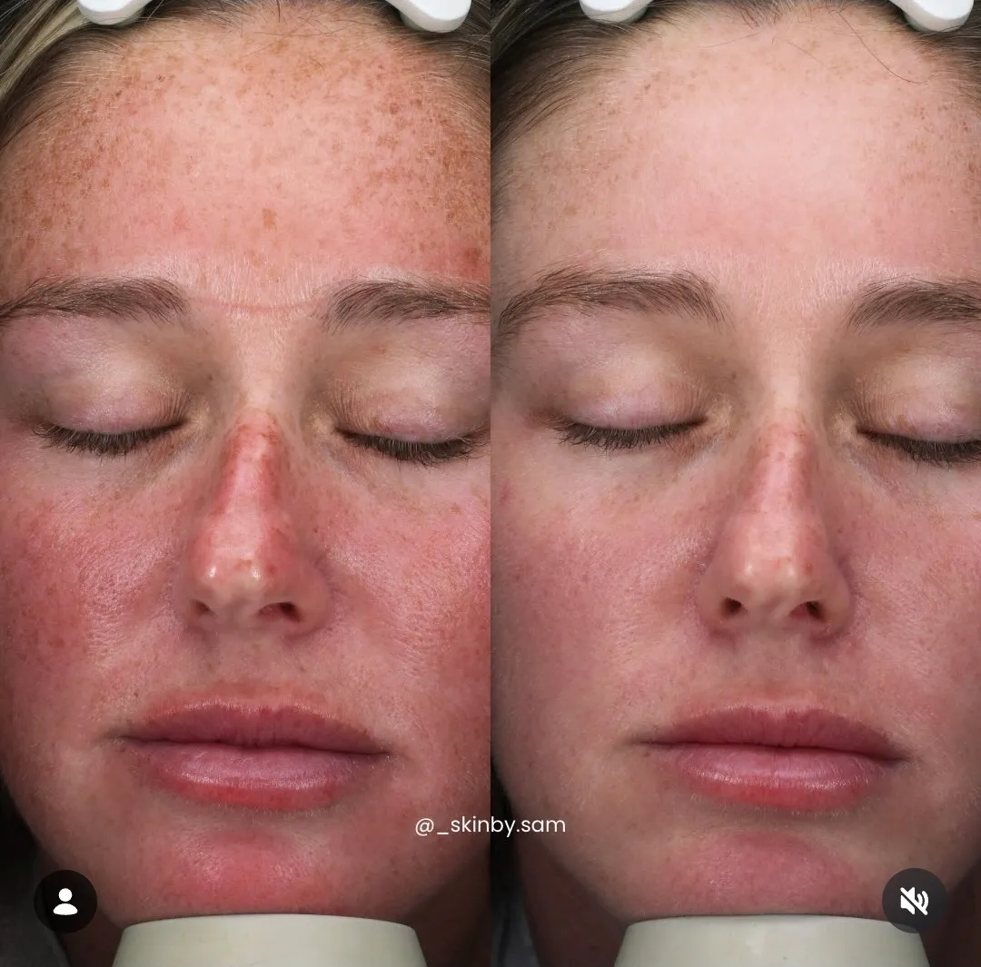 Before and after chemical peel brightening and evening the skin