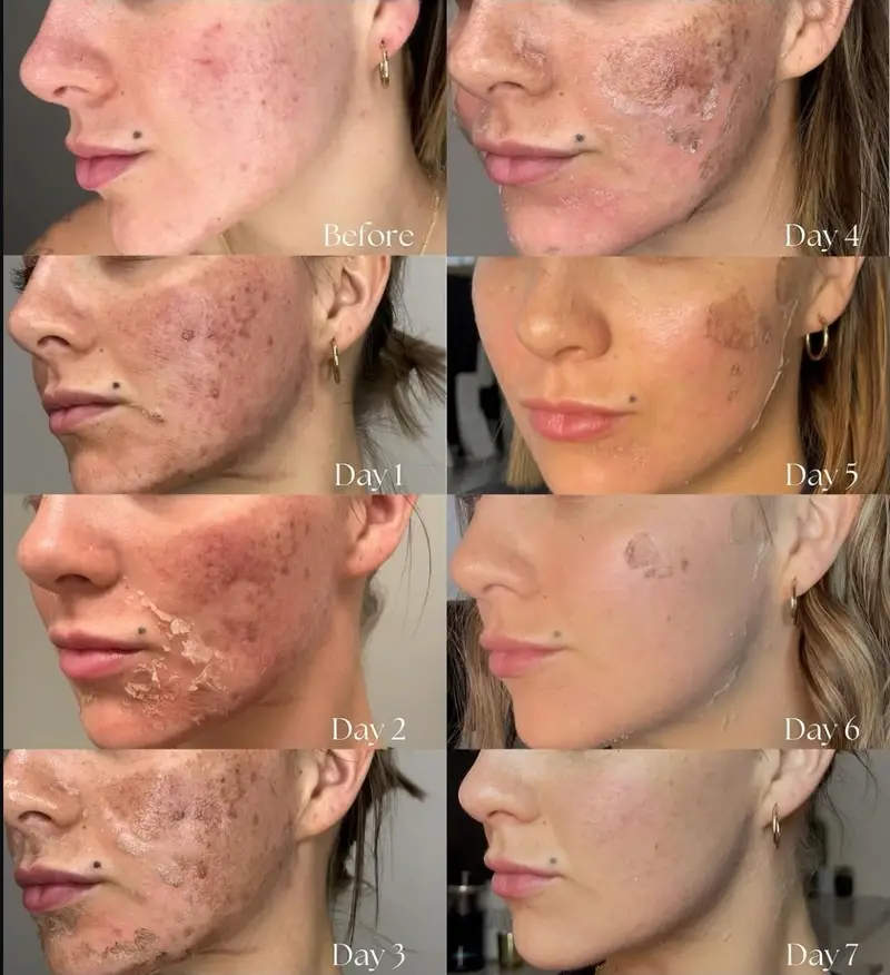 Before and after chemical peel reducing pigment and smoothing texture