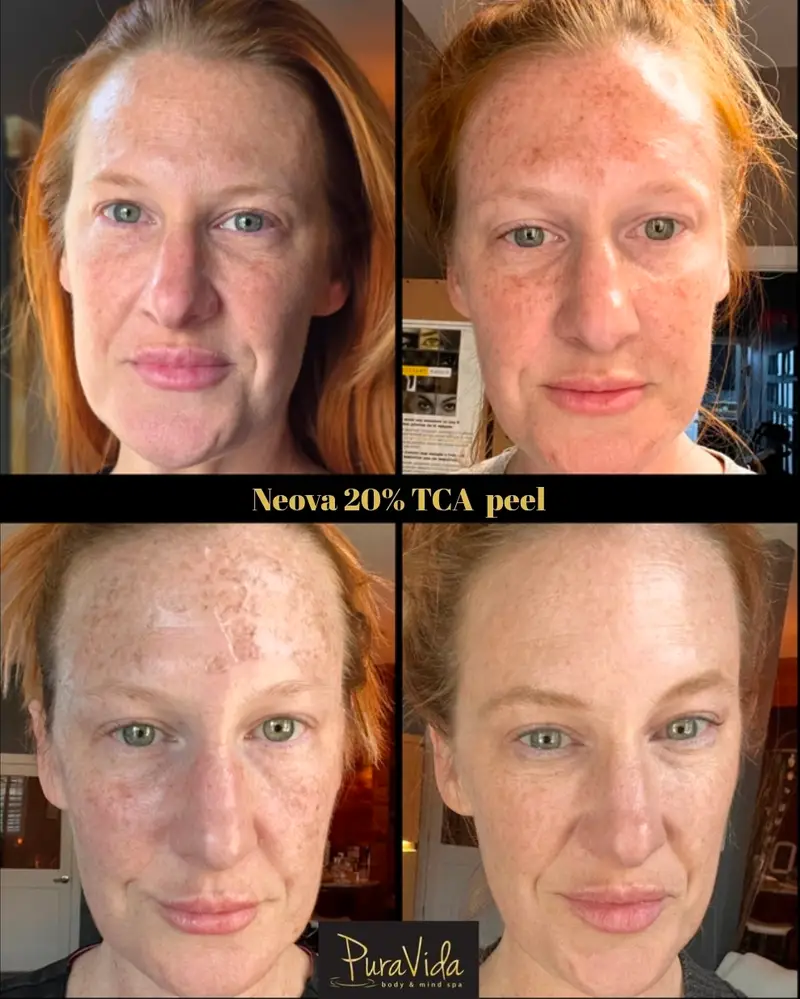 Before and after chemical peel for a refreshed, clearer complexion