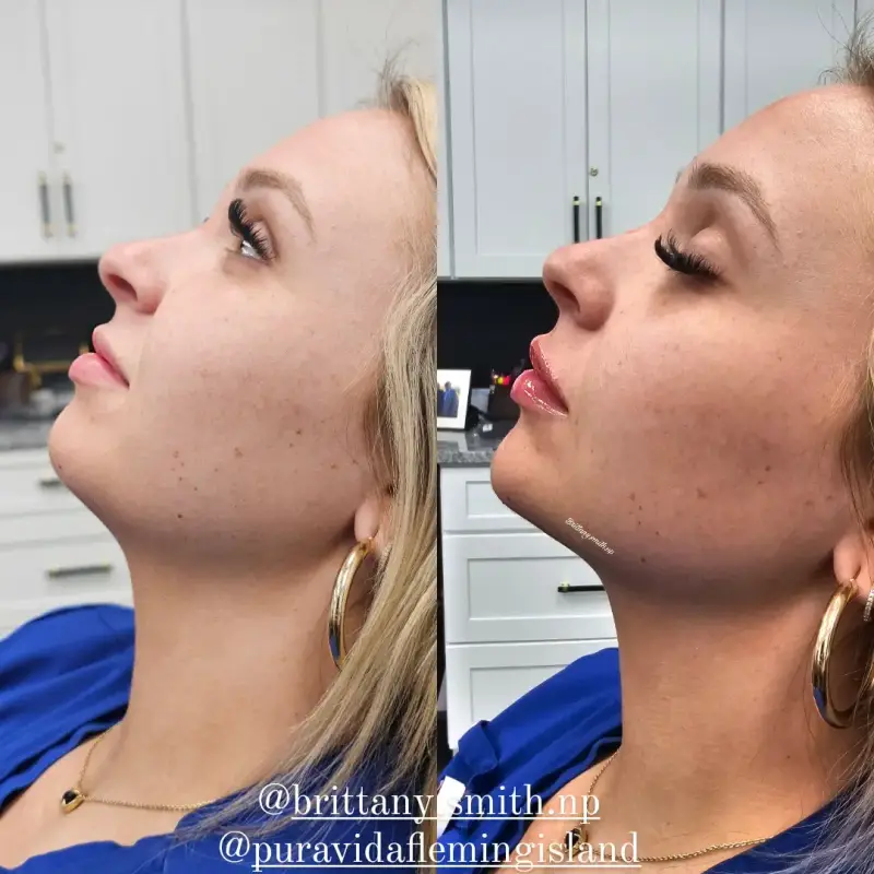 Before and after chin filler showing added chin projection and a straighter side profile