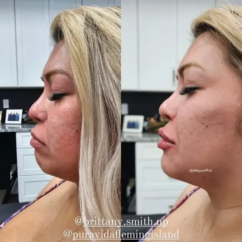 Before and after chin filler showing a stronger chin point and more defined jawline