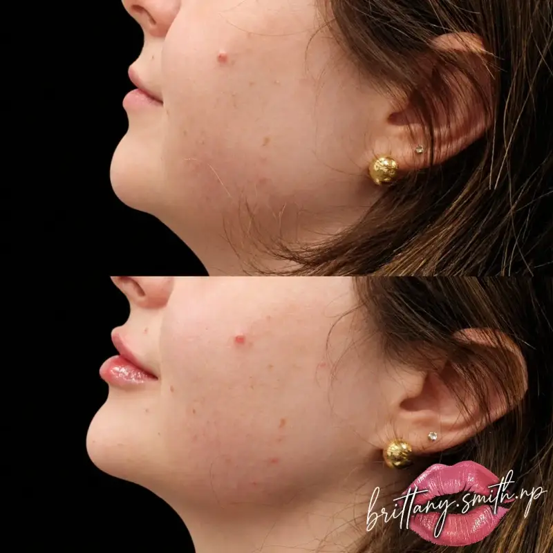 Before and after chin filler showing sharper chin definition and a longer jawline in profile
