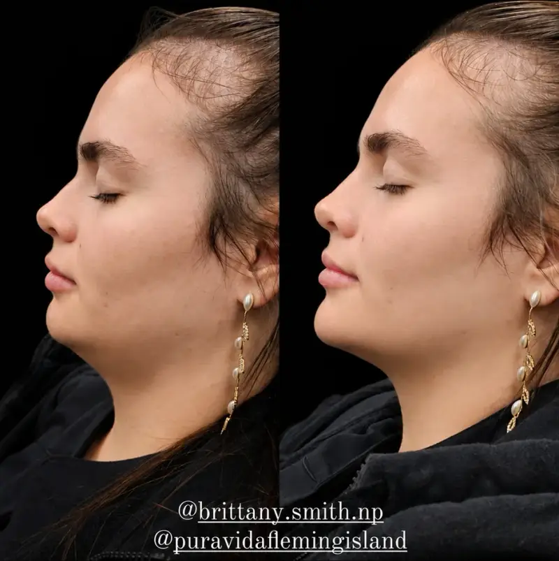 Before and after chin filler showing a firmer chin-to-neck line and better lower-face proportion