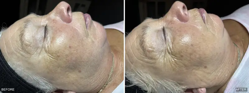 Before and after dermaplaning showing smoother skin texture and removal of fine facial hair