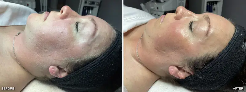 Before and after dermaplaning showing refined, more luminous facial skin