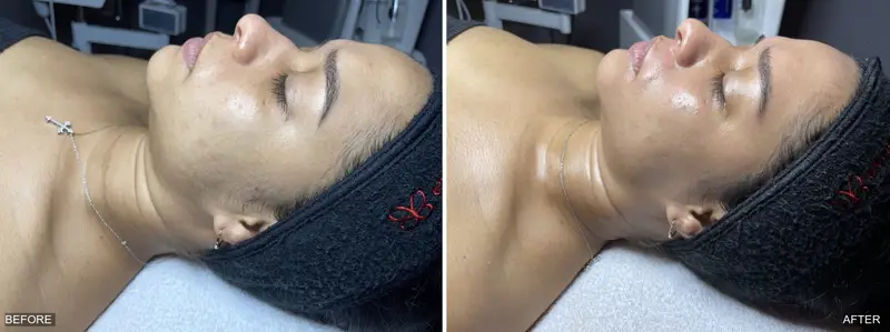 Before and after DiamondGlow facial showing brighter, more even skin tone