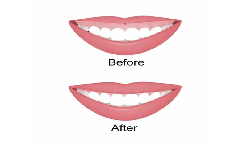 Do you have a Gummy Smile?
