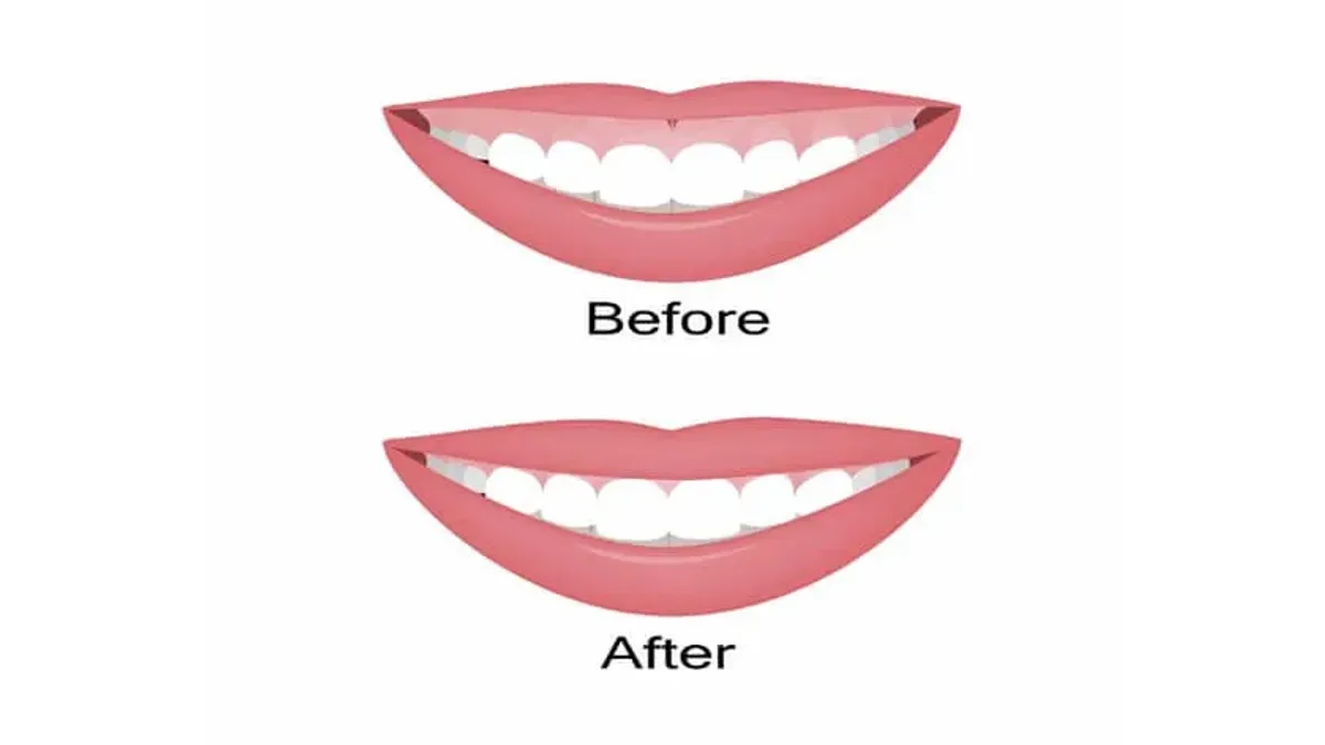 Do you have a Gummy Smile?
