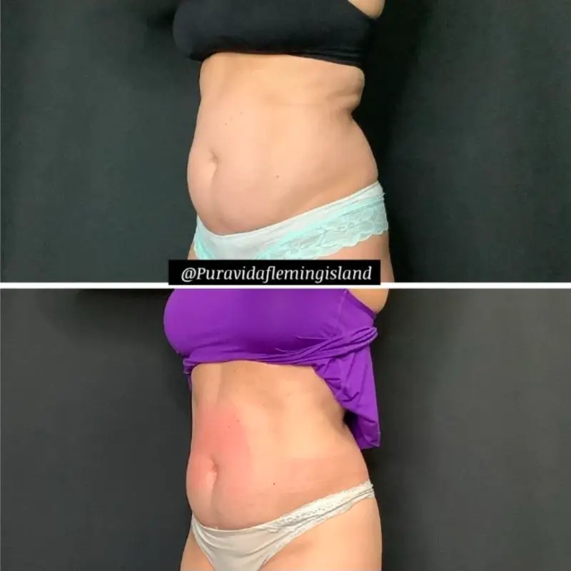 Before and after Emsculpt NEO showing a flatter, more toned abdomen