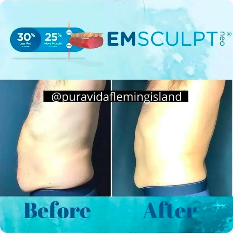 Before and after Emsculpt NEO reducing the midsection and toning muscle