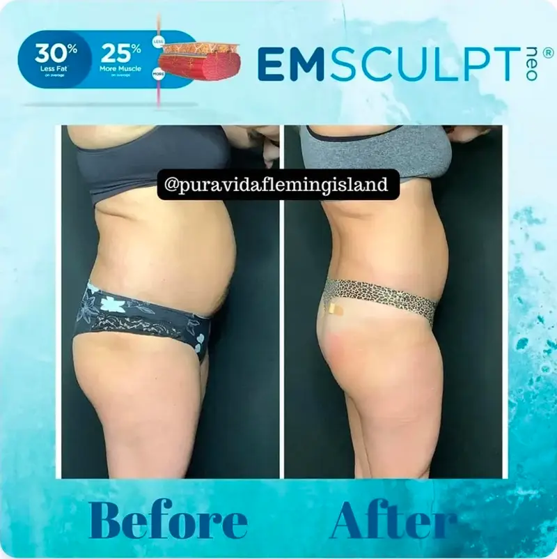 Before and after Emsculpt NEO for a tighter core