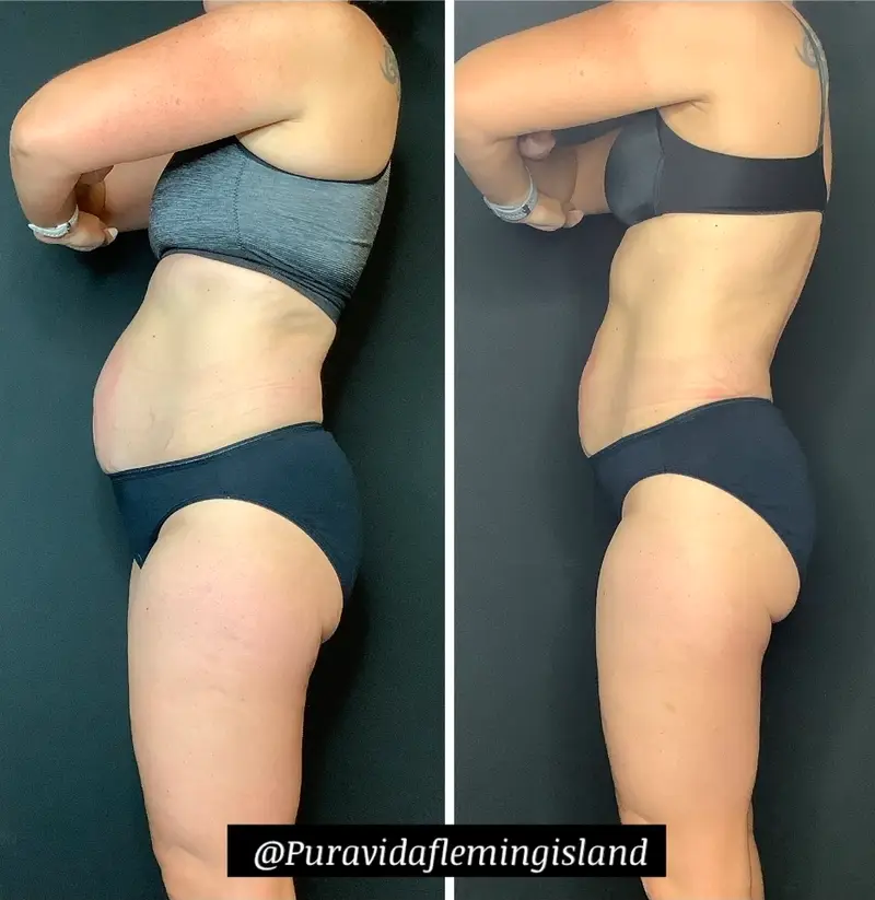 Before and after Emsculpt NEO contouring the midsection