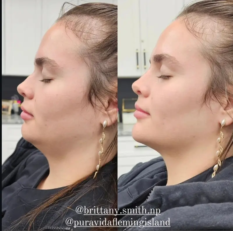 Before and after facial balancing with dermal filler refining the jawline and profile