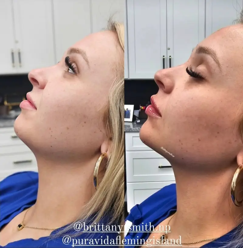 Before and after facial balancing improving chin projection