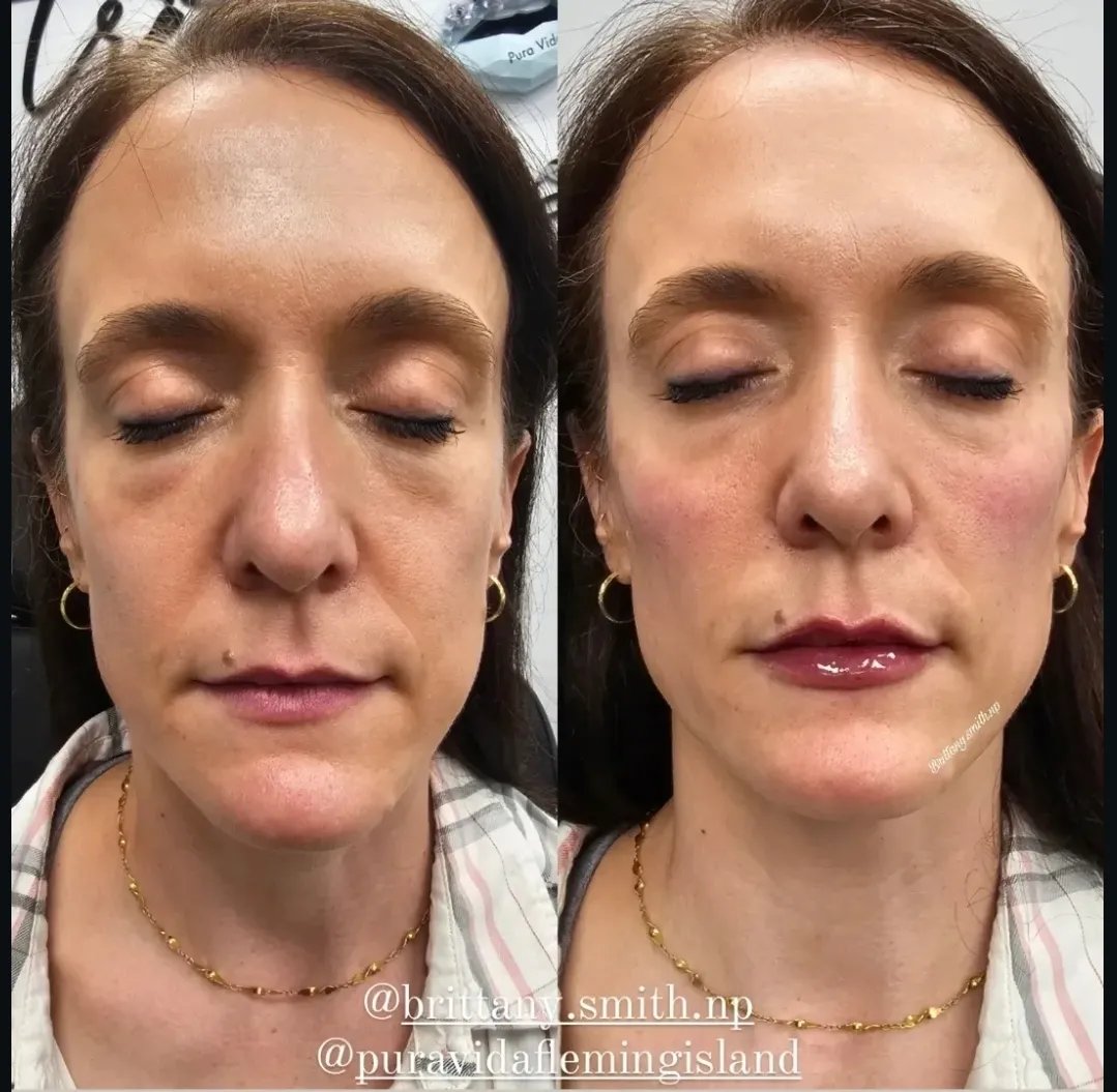 Before and after facial balancing restoring midface volume