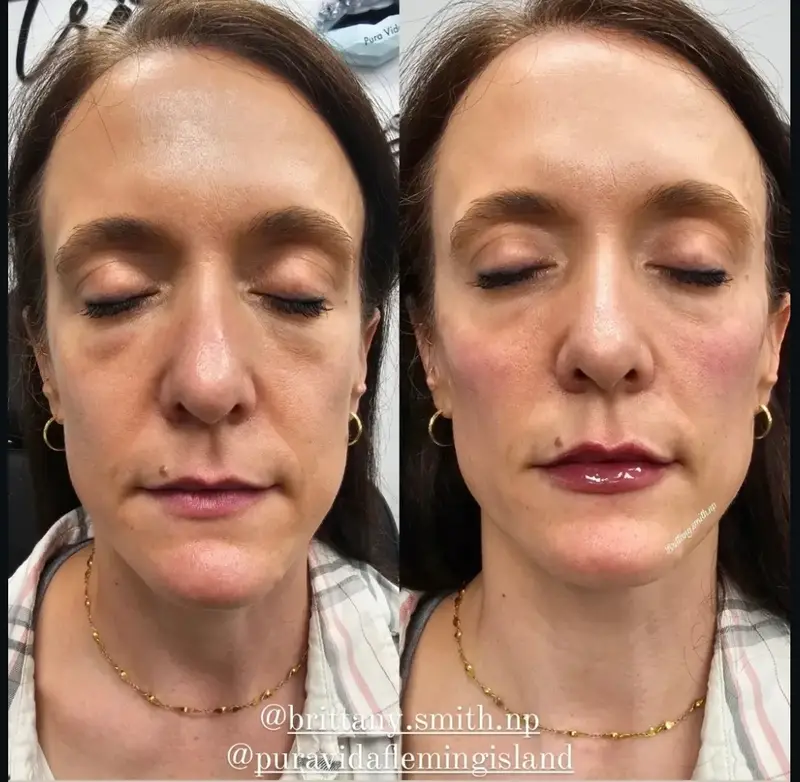 Before and after facial balancing restoring midface volume