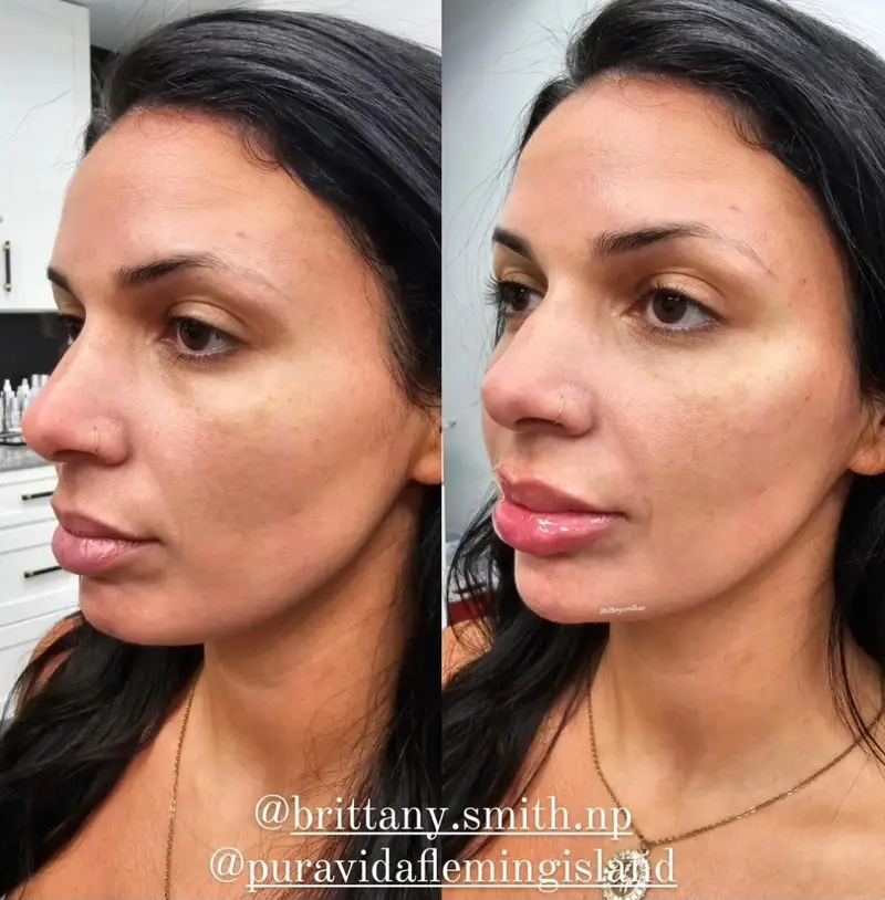 Before and after facial balancing harmonizing full-face proportions