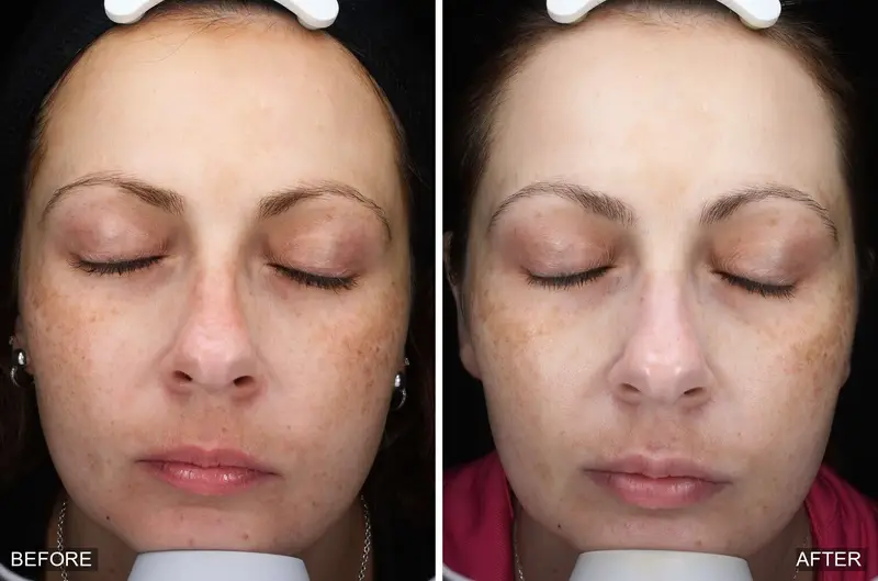 Before and after a medical-grade facial showing a clearer, more even complexion