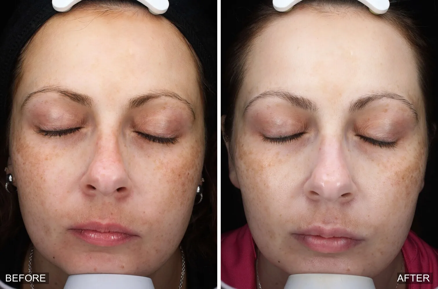 Before and after a medical-grade facial showing a clearer, more even complexion