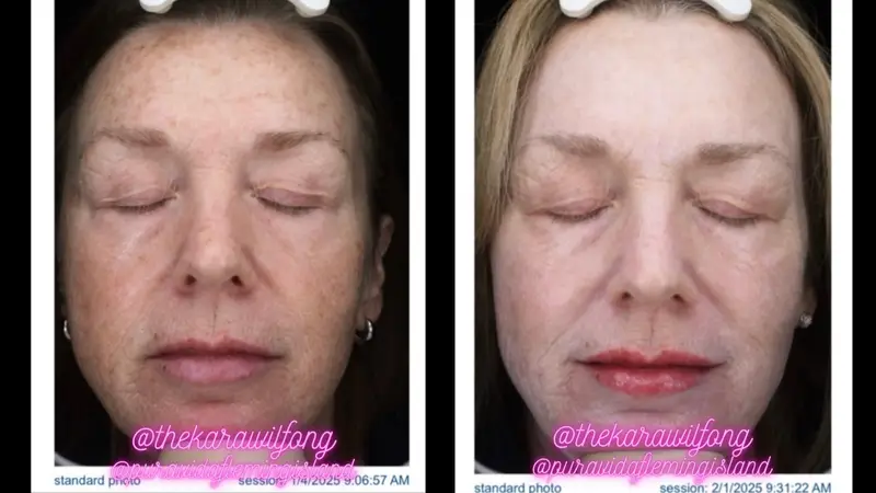 Before and after IPL photofacial reducing sun spots and evening skin tone