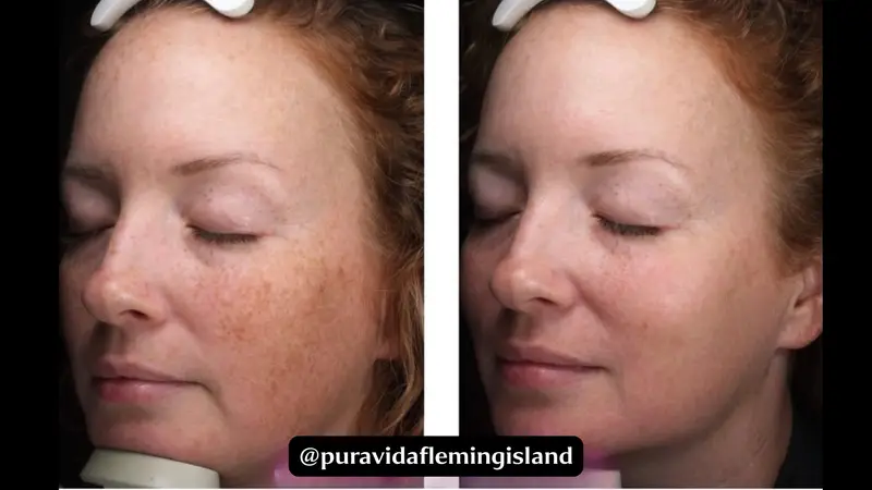 Before and after IPL photofacial for a clearer, brighter complexion