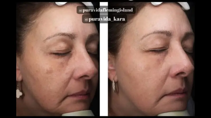 Before and after IPL photofacial reducing freckling and sun damage
