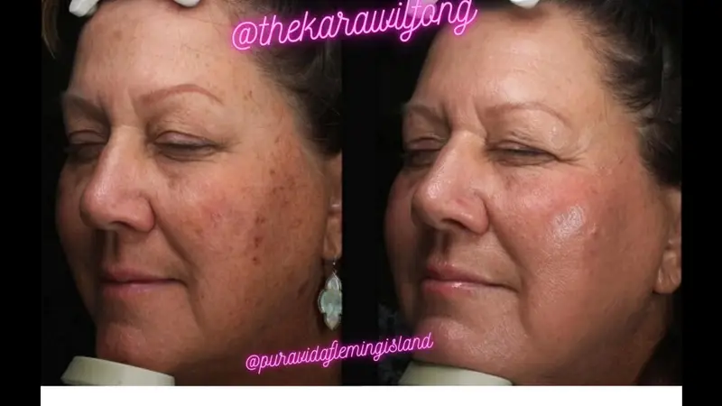 Before and after IPL photofacial evening overall skin tone