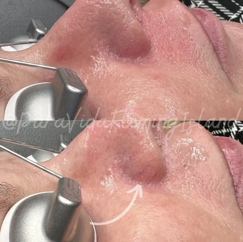 Before and after Laser Genesis showing reduced redness and smoother skin texture