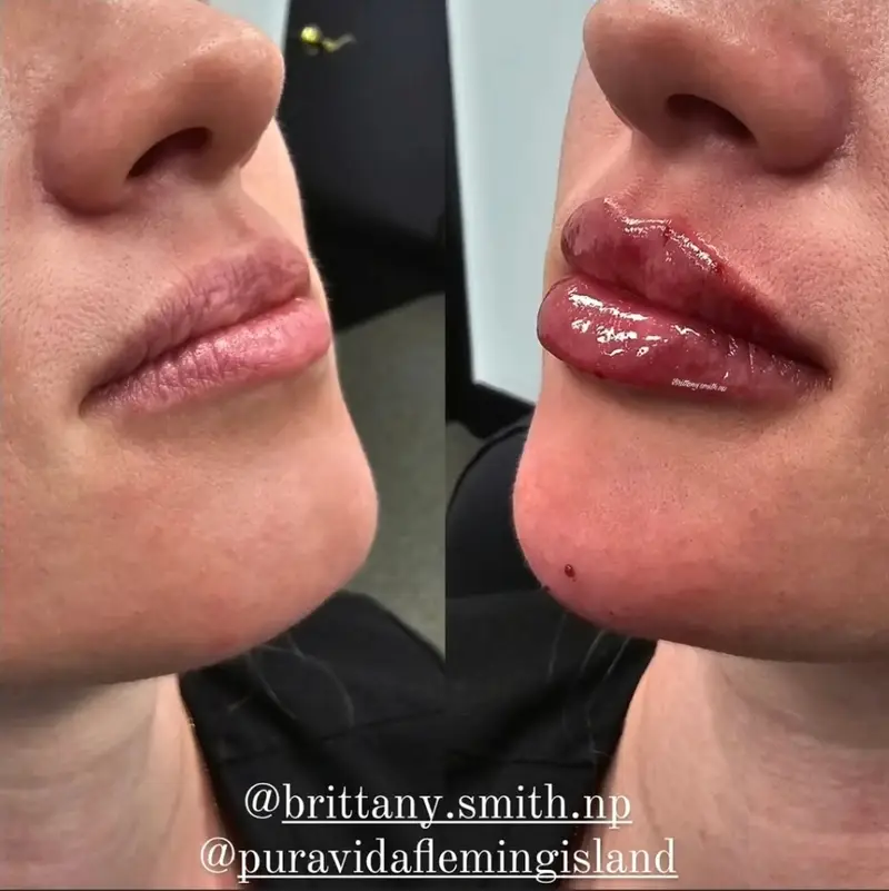 Before and after lip filler showing fuller, balanced lips