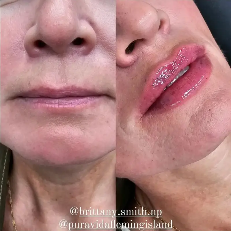 Before and after lip filler adding definition to the lips
