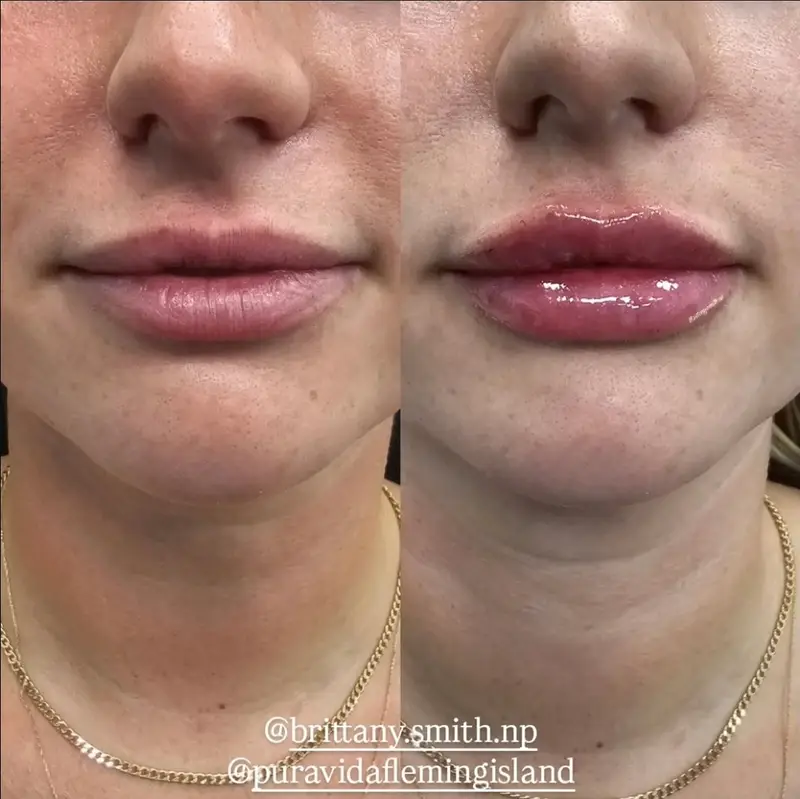 Before and after lip filler with subtle, natural volume