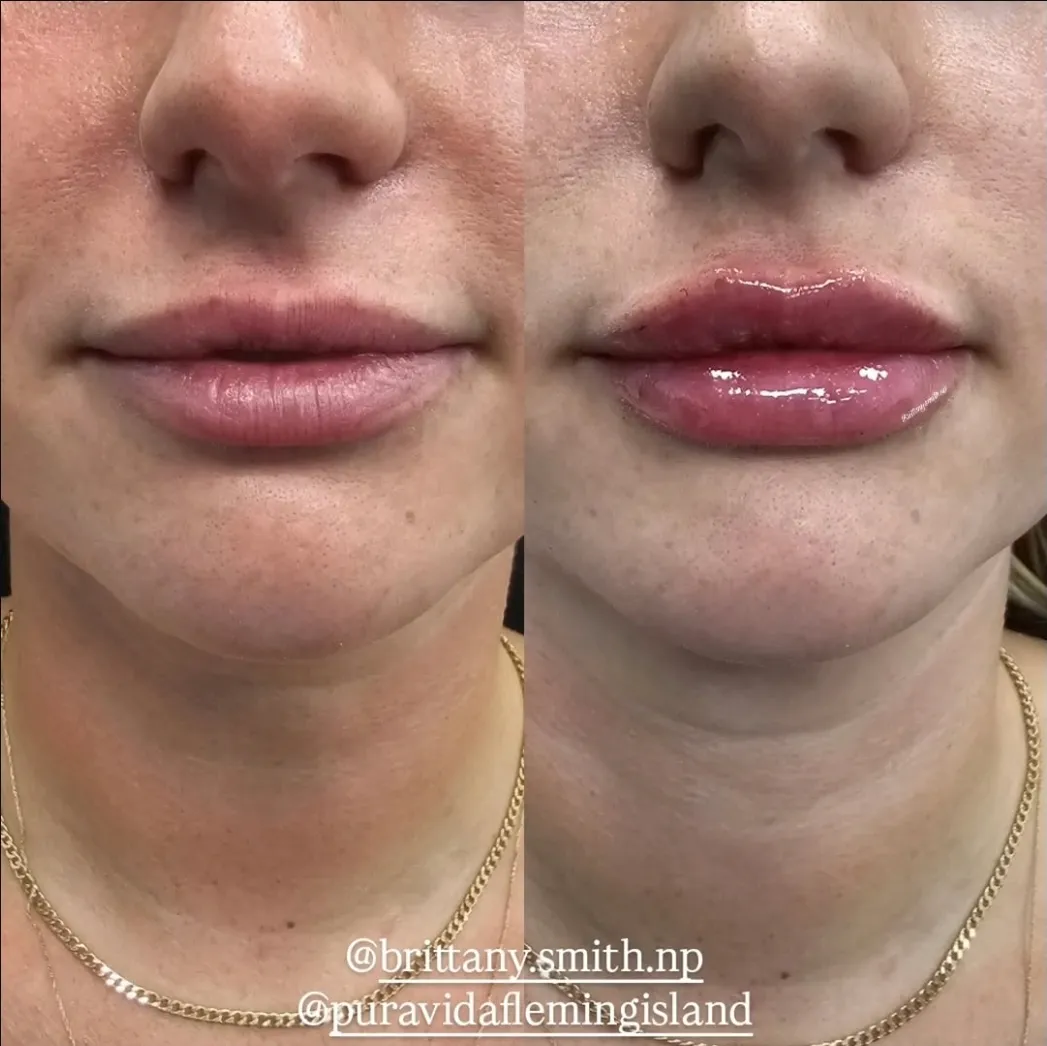 Before and after lip filler with subtle, natural volume