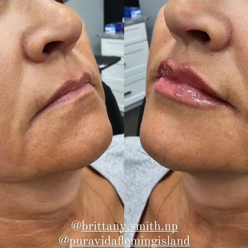 Before and after lip filler restoring lip shape and symmetry