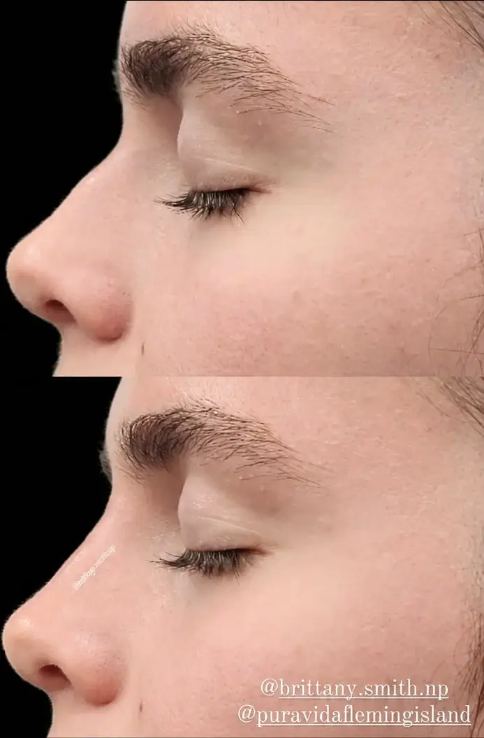 Before and after liquid rhinoplasty showing a smoother nasal bridge and lifted tip in profile