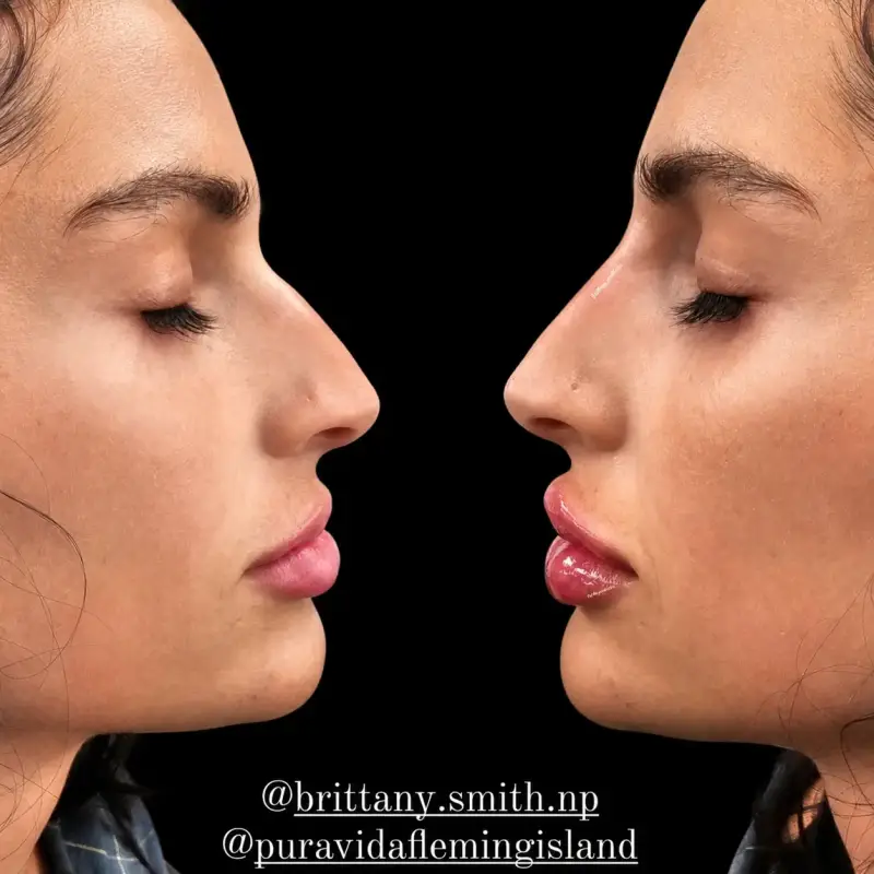 Before and after liquid rhinoplasty showing a straighter nasal profile after filler