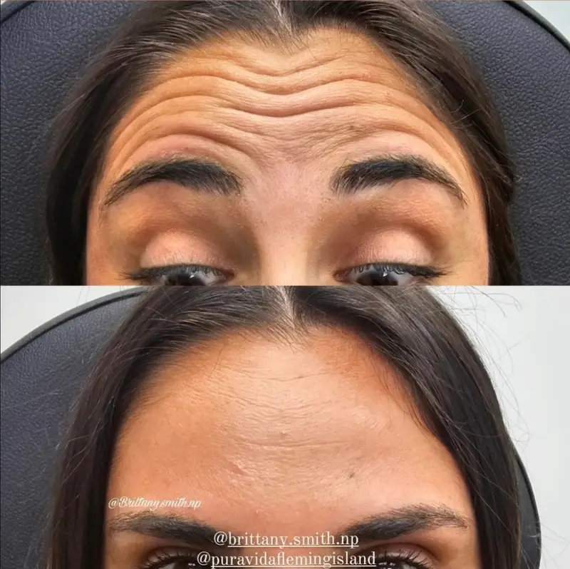 Before and after neurotoxin treatment showing smoother forehead lines