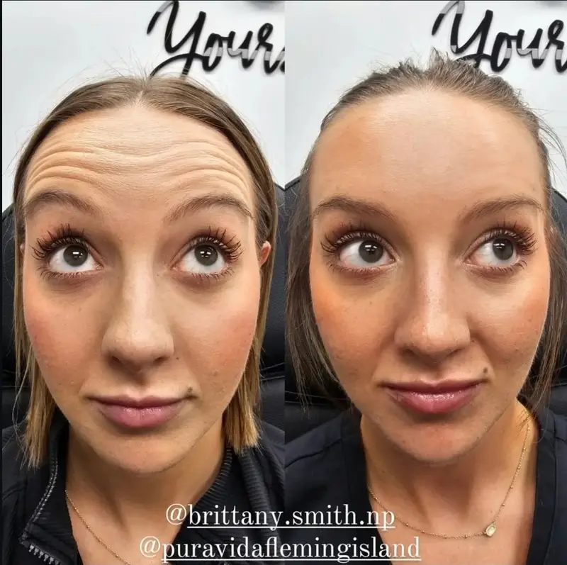 Before and after neurotoxin treatment on the upper face