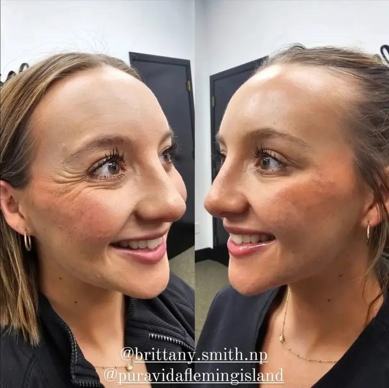 Before and after neurotoxin treatment smoothing crow’s feet at the corners of the eyes