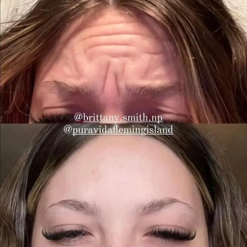 Before and after neurotoxin treatment reducing frown lines between the brows