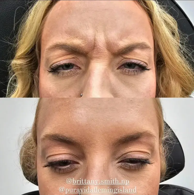 Before and after neurotoxin treatment relaxing frown lines for a smoother brow