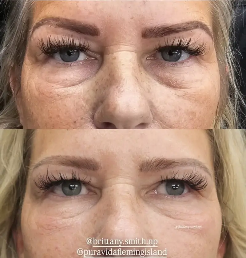 Before and after topical growth-factor treatment brightening and smoothing the under-eye area