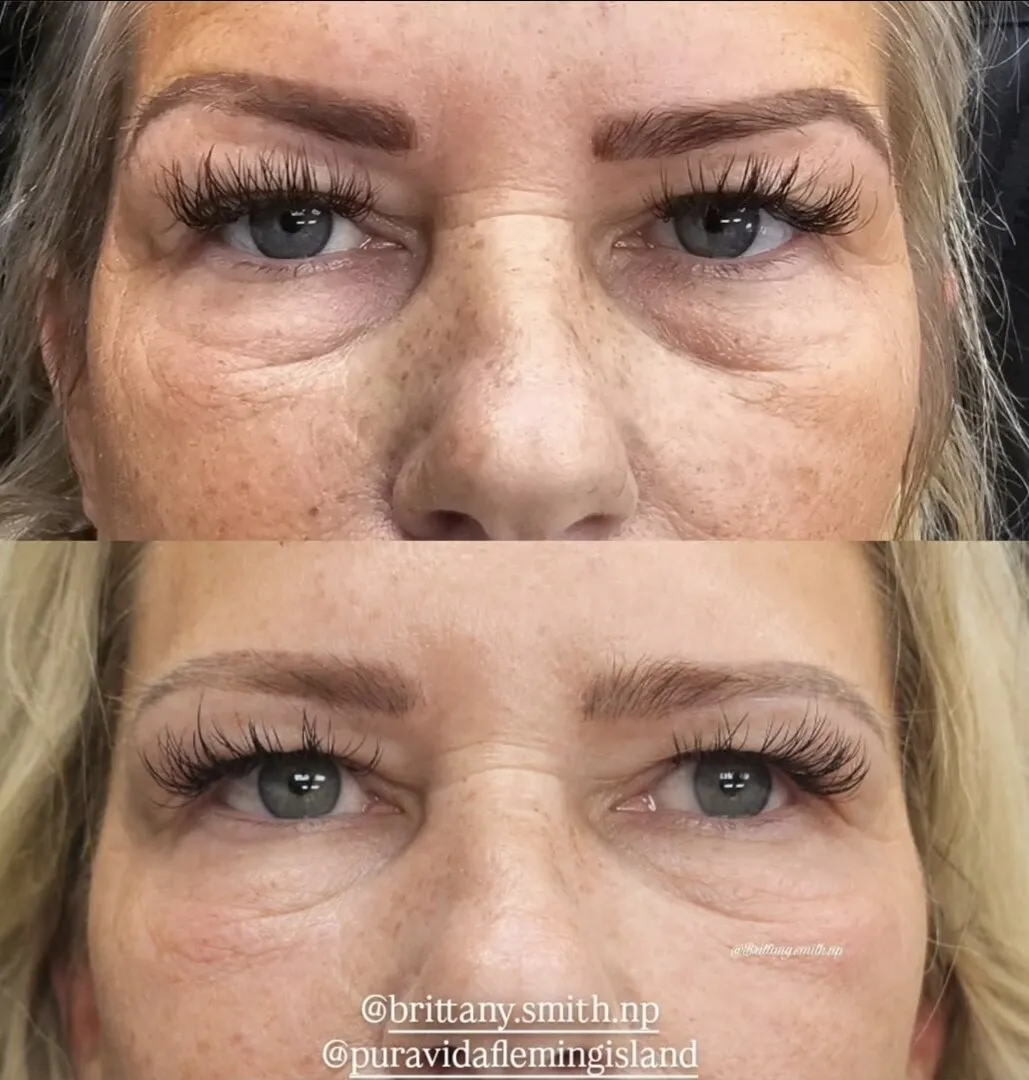 Before and after topical growth-factor treatment brightening and smoothing the under-eye area