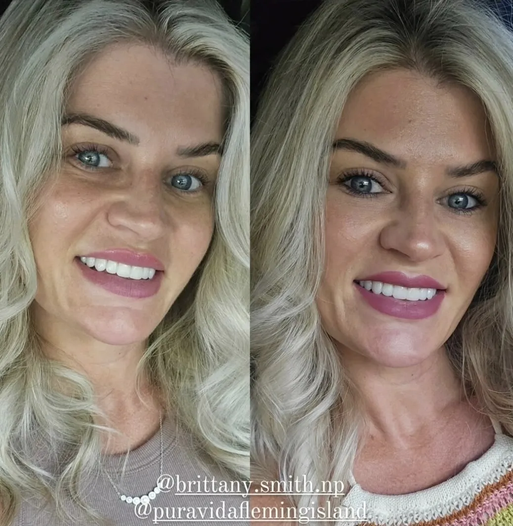 Before and after topical growth-factor treatment firming and refreshing the under-eye area