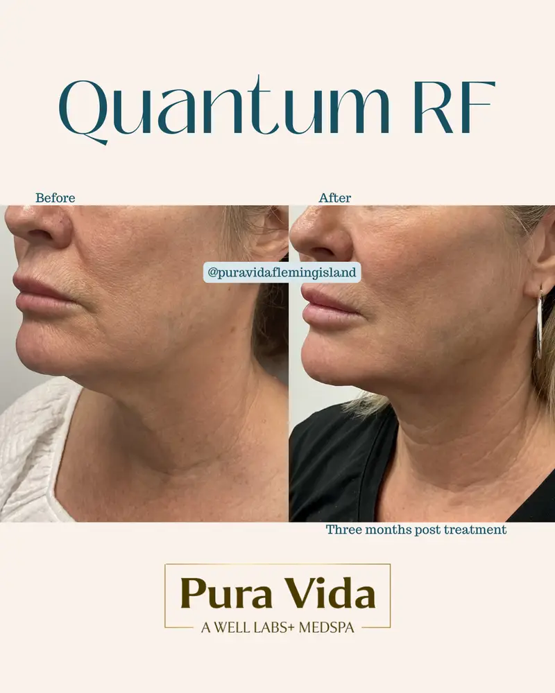Before and after Quantum RF showing a firmer jawline and lower face three months post treatment