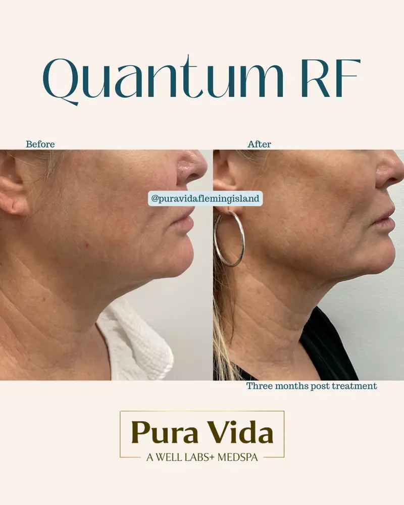 Before and after Quantum RF showing a tighter, smoother neck and jawline three months post treatment