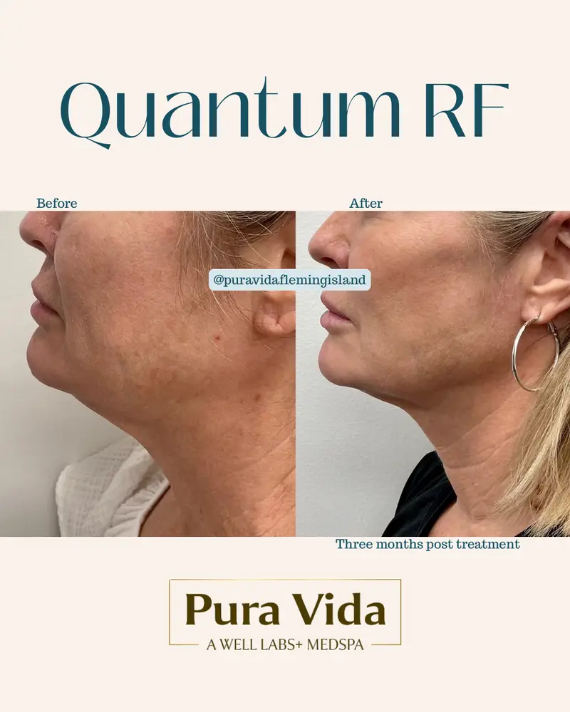 Before and after Quantum RF showing firmer skin along the neck and jaw three months post treatment